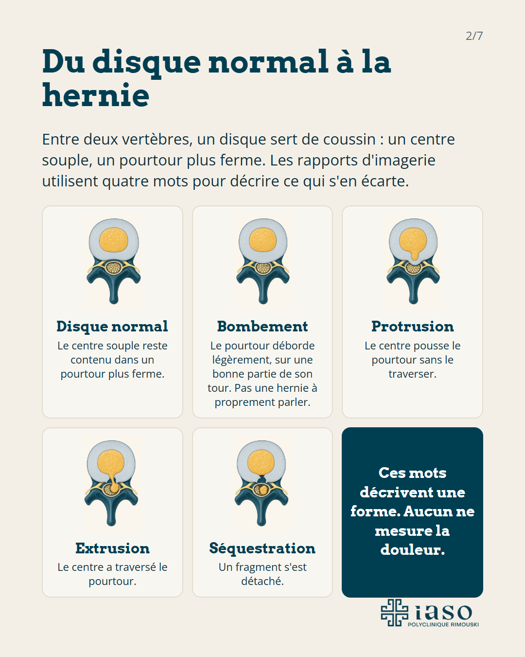 Du disque normal à la hernie : un disque normal, un bombement, une protrusion, une extrusion et une séquestration